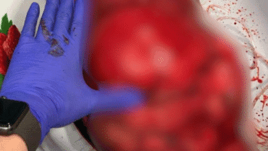 بعملية معقّدة .. أطباء روس ينجحون باستئصال ورم عملاق من جسم امرأة