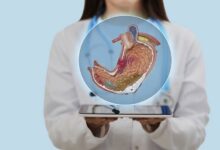 أطعمة تسبب قرحة المعدة